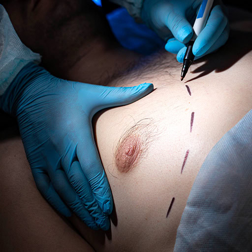 Gynekomastia, odstránenie, operácia.