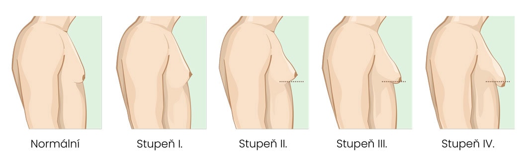Obrázok rôznych stupňov gynekomastie